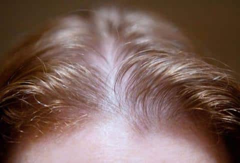 Baldness: Causes, Signs, And Ways To Improve